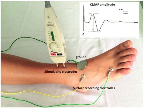 testing nerve conduction velocioty for drop foot|electrodiagnostic testing for peroneal neuropathy.